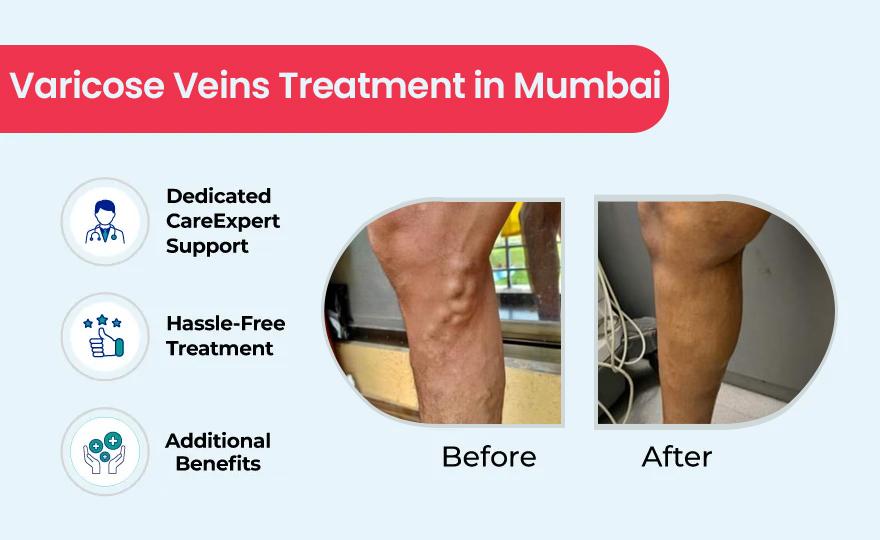 varicose veins treatment in Mumbai image 1