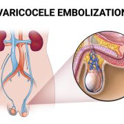 Varicocele-Embolization