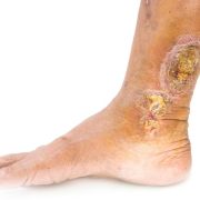 venous-leg-ulcers-e1508833041133